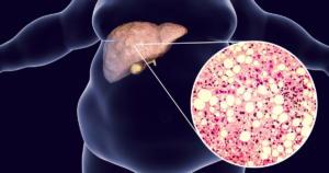 what is fatty liver disease?